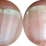 Tratamento para unhas quebradiças