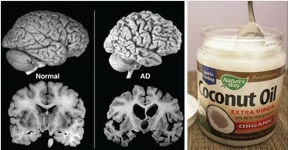 oleo-coco-alzheimer