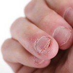 Sabe o que acontece se roer as unhas? É mais preocupante do que imagina!