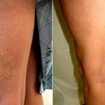 Alho combate inflamação e melhora circulação. É por isso que o óleo de alho vai eliminar suas varizes