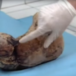 Os médicos acreditam ser um tumor. Mas o que eles tiram do corpo dela é ainda mais chocante.