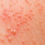Mamães, fiquem atentas ao ver essas bolinhas em seus filhos! Uma bactéria está rondando as crianças e é contagiosa!