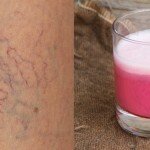 Tratamento natural para acabar com as varizes