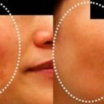Os Melhores Remédios para Eliminar Manchas de Melasma e Hiperpigmentação em Pouco tempo!