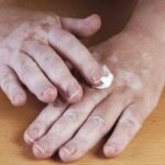 5 maravilhosos e incríveis remédios caseiros para vitiligo