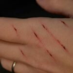 Arranhão e mordida de gato podem causar danos ao seu cérebro. Conheça os sintomas!
