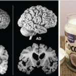 Um Homem com Alzheimer tomou 2 Colheres de Óleo de Coco 2 vezes por dia – E o incrível aconteceu!