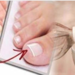 A Melhor e mais Econômica forma de Eliminar Fungo nas Unhas – E com apenas 1 Ingrediente!