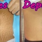 Receitas Caseiras Para Eliminar as Estrias!