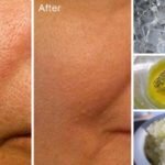 5 receitas naturais que vão te ajudar com os poros grandes e abertos