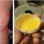 Remédio do Tempo da Vovó para Eliminar a Dor nos Joelhos e a Inflamação Rapidamente!