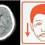 5 Sinais de que um Derrame está prestes a Acontecer – Você não pode Ignorá-los!