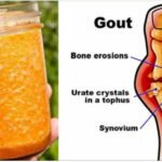 Cure a Gota para Sempre fazendo este Tratamento natural