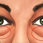 Os Melhores Tratamentos naturais para Eliminar as Bolsas abaixo dos Olhos